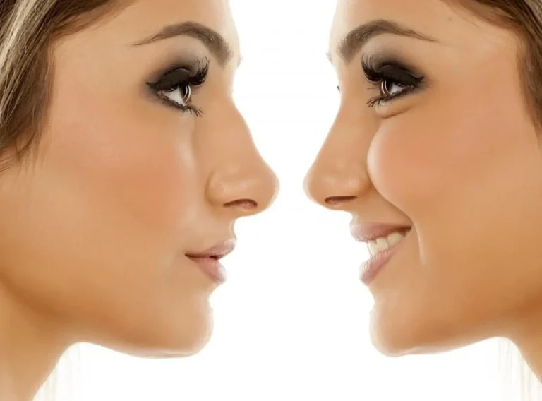 Rhinoplasty Surgery: Benefits, Techniques, and Expected Results