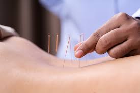 What Is Dry Needling and How Can It Relieve Your Pain? A Casper Chiropractor at Martens Chiropractic Explains