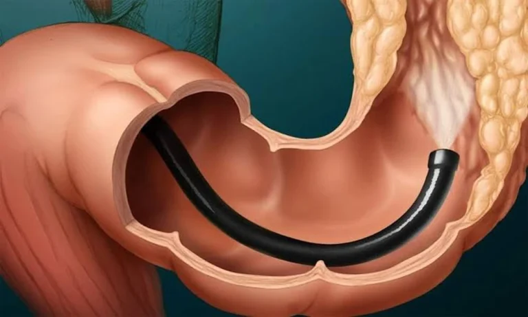 Signs Your Digestive Symptoms Need a Colonoscopy