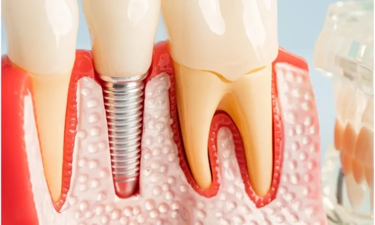 8 Ways to Make Dental Implants More Affordable: Practical Advice From Stubbs Dental and Other Utah Providers